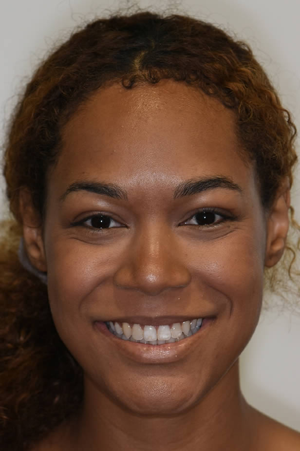 invisalignsurgery-full-face2